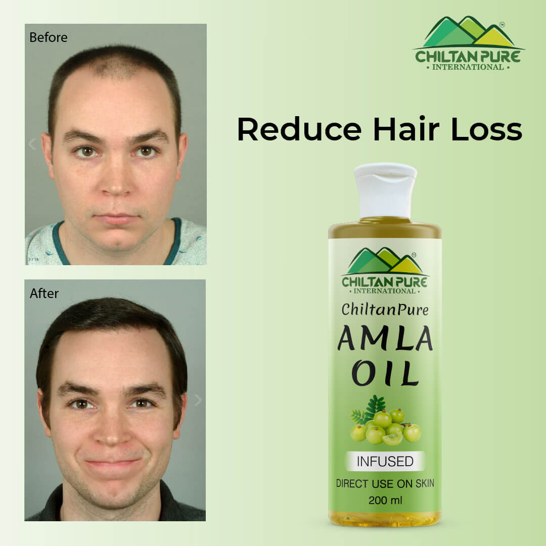 Amla Oil – Lessen Hair Loss, Boosts Hair Growth, Treats Dry Scalp & Prevents Premature Hair Greying 200ml - ChiltanPure