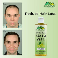 Amla Oil – Lessen Hair Loss, Boosts Hair Growth, Treats Dry Scalp & Prevents Premature Hair Greying 200ml - ChiltanPure