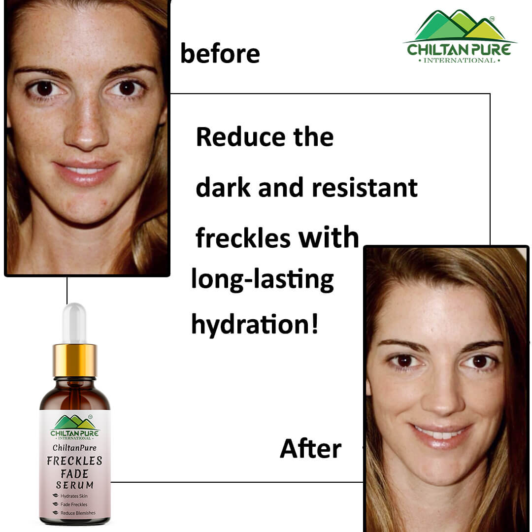 Freckles Fade Serum – Hydrates Skin, Fade Freckles, Reduce Blemishes & Lighten Pigmentation 30ml - ChiltanPure