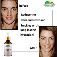 Freckles Fade Serum – Hydrates Skin, Fade Freckles, Reduce Blemishes & Lighten Pigmentation 30ml - ChiltanPure