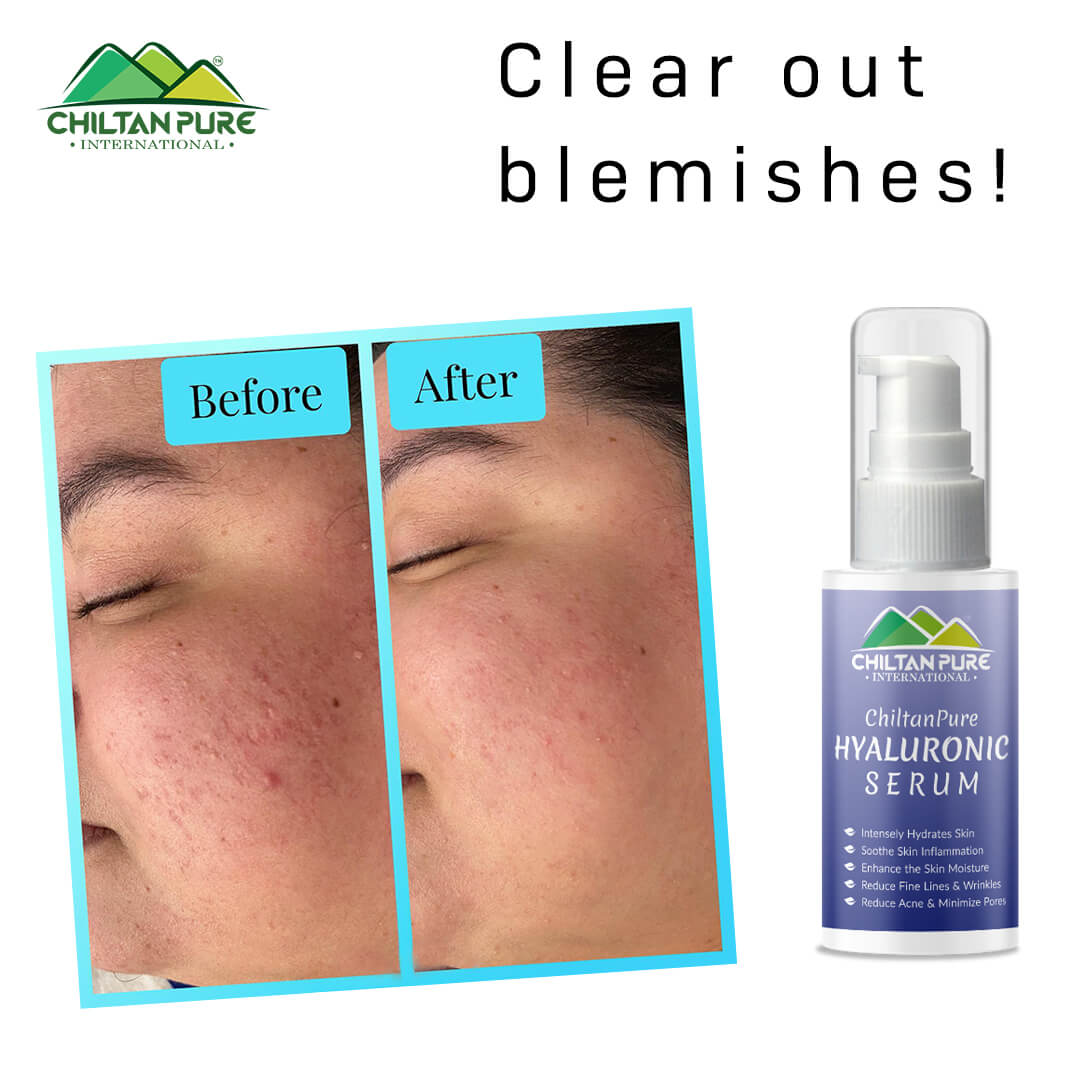 Hyaluronic Acid Serum – Treats wrinkles & Acne, Best at Hydrating Skin For Smooth and Radiant Skin 50ml - ChiltanPure