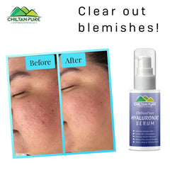 Hyaluronic Acid Serum – Treats wrinkles & Acne, Best at Hydrating Skin For Smooth and Radiant Skin 50ml - ChiltanPure