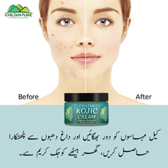 Kojic Cream – Affordable and quality body lotion cream, prevents hyperpigmentation, fades dark spots, treats melasma, minimizes discoloration – 100% pure organic 50ml - ChiltanPure