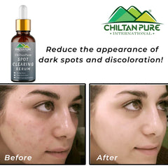 Spot Clearing Serum – Unclog Pores, Reduce Dark Spots & Fade Hyperpigmentation - ChiltanPure