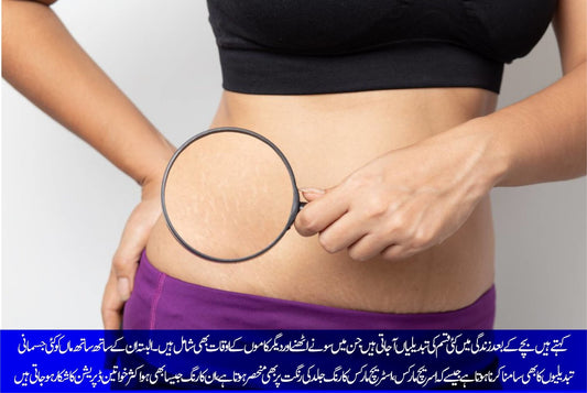 اسٹریچ مارکس دور کرنے کے گھریلو ٹوٹکے - ChiltanPure