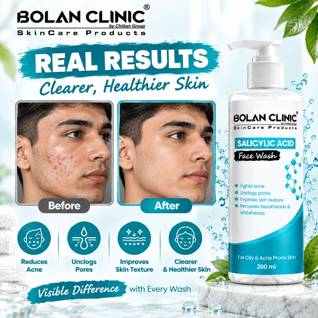 Salicylic Acid Face Wash – Fights Acne, Removes Blackheads & Whiteheads - ChiltanPure