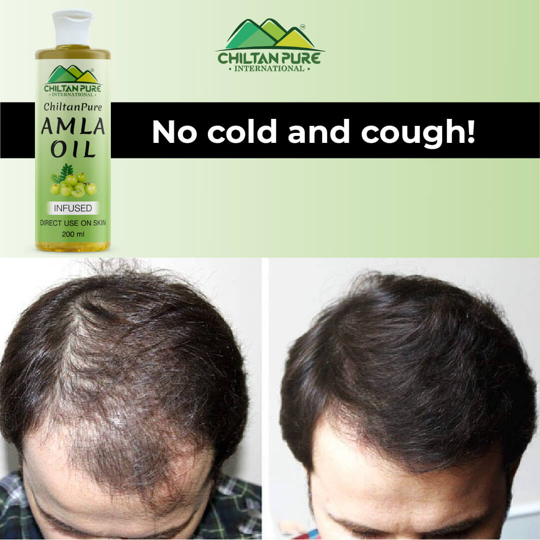 Amla Oil – Lessen Hair Loss, Boosts Hair Growth, Treats Dry Scalp & Prevents Premature Hair Greying 200ml - ChiltanPure