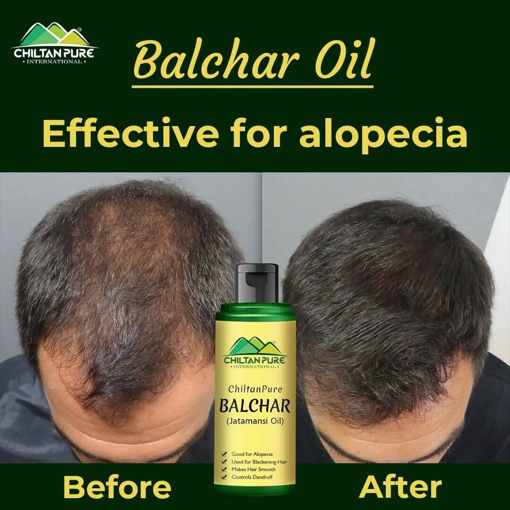 Balchar (Jatamansi) Oil – Effective for Alopecia, Enlarges Follicular Hair Size & Prevents Scalp Infections 120ML - ChiltanPure