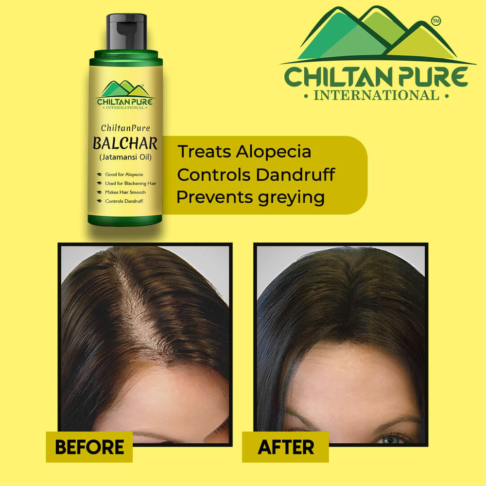 Balchar (Jatamansi) Oil – Effective for Alopecia, Enlarges Follicular Hair Size & Prevents Scalp Infections - ChiltanPure