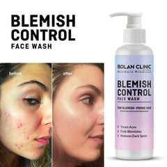 Blemish Control Face Wash - Made with 2% Salicylic Acid & Niacinamide, Treats Acne, Fades Blemishes & Reduces Dark Spots - ChiltanPure