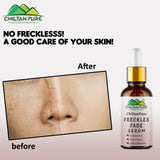 Freckles Fade Serum – Hydrates Skin, Fade Freckles, Reduce Blemishes & Lighten Pigmentation 30ml - ChiltanPure